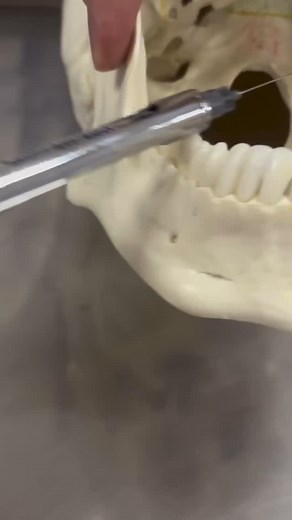 Posted • @ajfogaca_est Bloqueio do nervo alveolar inferior: anestesia usada para procedimentos na mandíbula, bloqueando a dor nos dentes inferiores, gengiva, lábio e mucosa bucal. Inferior alveolar nerve block: anesthesia used for mandibular procedures, blocking pain in lower teeth, gums, lip, and buccal mucosa. | identistry