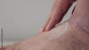 Psoriasis. The man rubs the ointment into the affected part of the foot with psoriatic plaques, rashes and wounds. Close up.