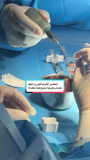 @dr.emanalbluwi تحضير القرنية قبل زراعتها لمصاب بقرنية مخروطية متقدمة #زراعة_قرنية #تبرع_قرنية_العين #زرع_القرنية #إيمان_البلوي #أفضل_دكتور_عيون_الرياض