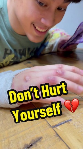 Self-harm is when you intentionally harm yourself as a way of coping with difficult emotions, painful memories, or overwhelming situations and experiences. For individuals with Autism, self-harm can be a method of dealing with the challenges they face in processing and expressing their emotions. It is important to note that self-harm is not exclusive to individuals with Autism, but they may be more susceptible to engaging in these behaviors due to difficulties in communication and social interac