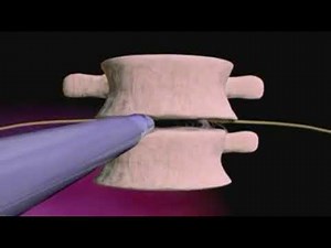 L'arthrodèse Lombaire