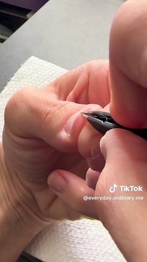 Effective Splinter Removal Techniques