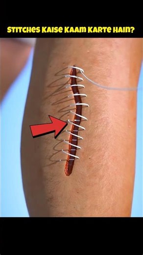Stitches Explained – How Your Skin Heals!