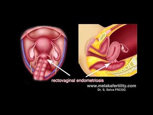 Laparoscopic surgery for endometriosis • Video • MEDtube.net