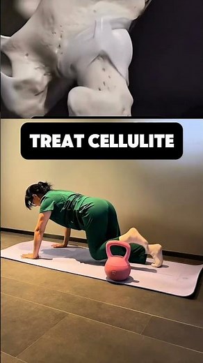 TREAT CELLULITIS 🔥✨ #1million