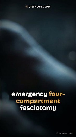 Acute Compartment Syndrome in Tibial Shaft Fractures: Emergency Fasciotomy