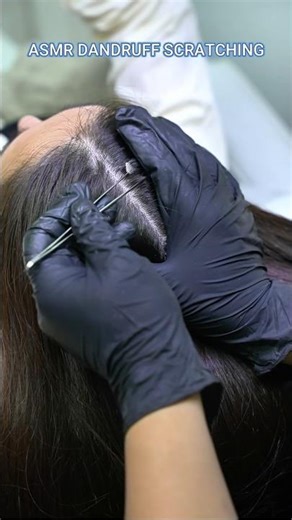 Asmr dandruff scratching #asmr #asmrscalp #asmrscalptreatment @MadPASMR