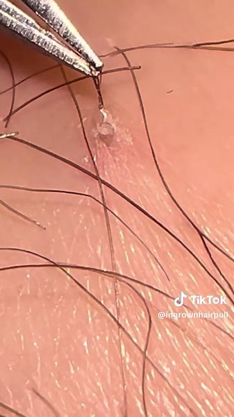 Watch it unravel 🤢 #ingrownhair #ingrownhairremoval #ingrown #gross #tweezers #pimplepopperaddict #derma #dermatologist #hair #satisfying #ingrownhairpull