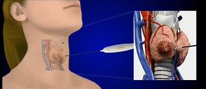 1.7K views · 34 reactions | Medical Grand Rounds host and thyroid expert Dr. Steven Hodak talked about radio frequency ablation to treat thyroid nodules - but what does this mean? Check out this handy video! | Doctor Radio | Facebook