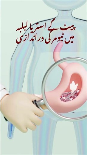 Pancreatic Cancer | Stomach Cancer Symptoms in Urdu | Stomach Cancer ki alamat in urdu
