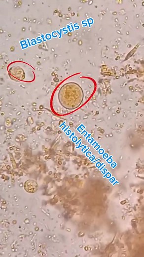 65K views · 706 reactions | Stool sample  #lablife #microbiology | Lab life | Facebook
