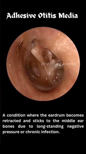 Adhesive otitis media ....also known as glue ear with tympanic membrane retraction