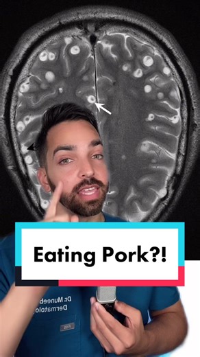 Also, it’s forbidden in some religions #dermdoctor #dermatologist #learnontiktok #tiktokpartner #tapeworm #neurocysticercosis