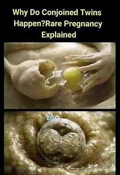 Conjoined Twins Vs Identical Twins embryonic formation: Siemens Twins process #pregnancy #twins