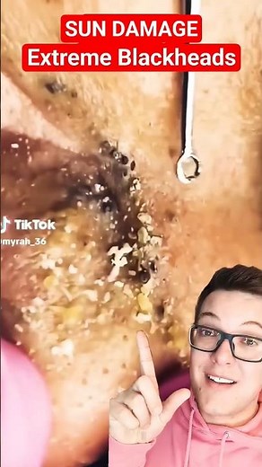 The Sun Causes This - WILDEST BLACKHEAD REMOVAL #shorts