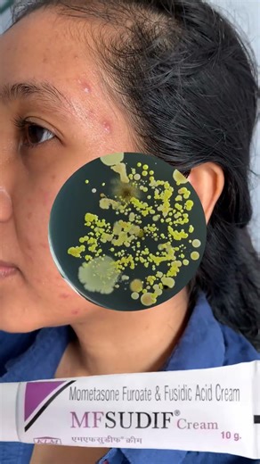 MFSUDIF Cream uses in Hindi and mechanism of action, infected skin treatment