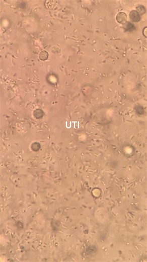 Understanding UTI Symptoms and Treatments