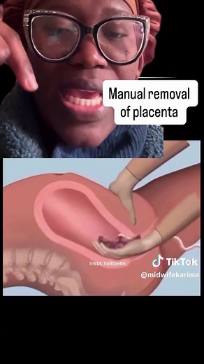 Manual Removal of Placenta Explained