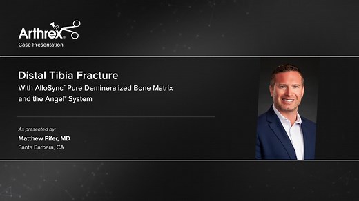 Distal Tibia Fracture With AlloSync™ Pure Demineralized Bone Matrix and the Angel® System