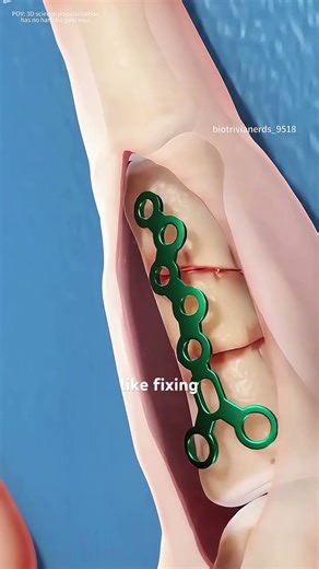 How Finger Frcature Surgery Is Performed(3D animation) #music #motivation #epic