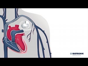 Thérapie de resynchronisation cardiaque - Comment cela fonctionne-t-il ?