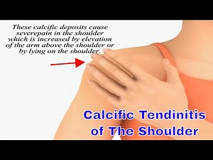Calcific Tendinitis of the Shoulder: Causes, Symptoms, and Effective Treatments