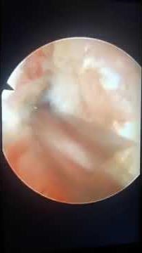 L4 L5 transforaminal discectomy