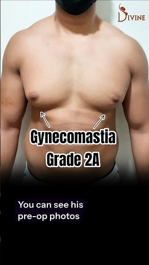 Grade 2 Gynecomastia Surgery | 360° Chest Contouring & Transformation | Plastic Surgeon in Delhi
