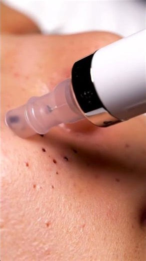 “Deep Nose Blackhead Suction – Clear Camera Focus!”