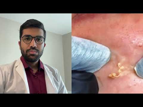 Ultimate Pimple Popping Compilation | Oddly Satisfying