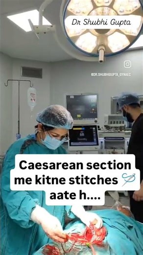 how many stitches are there in c section???