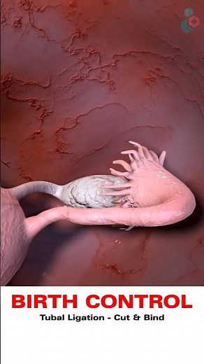 Birth Control | 3D Medical Animations | #BirthControl #TubalLigation #CutandBind