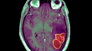 Brain infections in kids are rising in this state and doctors aren't sure why