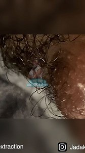 Jada Kennedy on Instagram: "Removing an ingrown hair on the back of a neck."