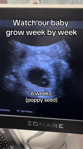 I cannot believe how much this little bean has grown! I love seeing them every week! Hopefully we will find out what bean is next week! Just waiting for our results to come back! #pregnancy #fyp #rainbowbaby #firsttrimestrepregnancy #pregnant #pregnantlife #ultrasound #weeklyultrasounds #pregnancyweekbyweek #baby #pregnancyafterloss #secondaryinfertility