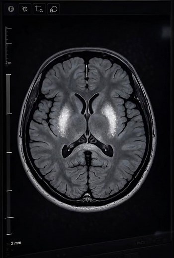 When Metal Accumulates in the Brain | Wilson’s Disease