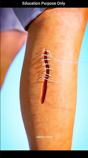 How Stitches Work 🤔