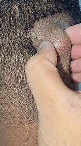 1.9M views · 3.6K reactions | Trichilemmal cyst. | Dr Khaled's Tumour Helpline | Facebook