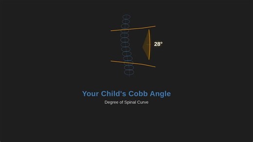 @everyone The Cobb angle is the most commonly referenced measurement in scoliosis, but it’s often misunderstood. The Cobb angle measures the degree of spinal curvature seen on an X-ray. It helps classify scoliosis severity and track change over time. But it does not explain why a curve behaves the way it does, whether it will progress, or how someone will feel. Two people can have the same Cobb angle and very different experiences. One may remain stable with little discomfort. Another may progre