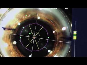 RoboMarker Corneal Marking System explained by Dr. Alan Brown