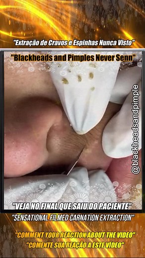 ✅Extraction of Blackheads and Pimples Never Seen✅ ✅Squeezing Blackheads on Face✅ 🎬If you liked the Video Blackheads and Pimples Comment Your Reaction on the Video 💖🤳 Follow, Like and Share to help bring more videos. #acne #cravos #blackheads #pimplepop #pimples #squeezeyuk #satisfying #videoviral #cravosgigantes #extractionsatisfaciton #estetica