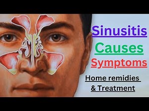Sinusitis Infection || Symptoms, Causes, & Treatment options