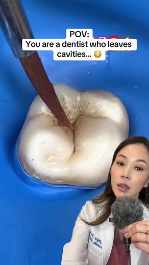 Dentistry Explained 174940303 | This is a creative way for a dentist to do a filling and make it exactly as it looked before with the inverse stamping technique! Creator credit: @Dr. Diler Cruz #dentist #filling #greenscreenvideo