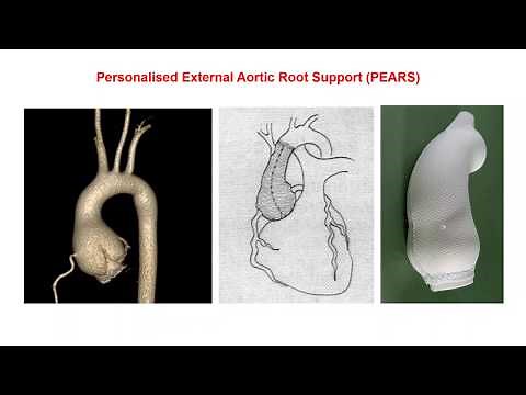 Personalised External Aortic Root Support (PEARS) Surgery
