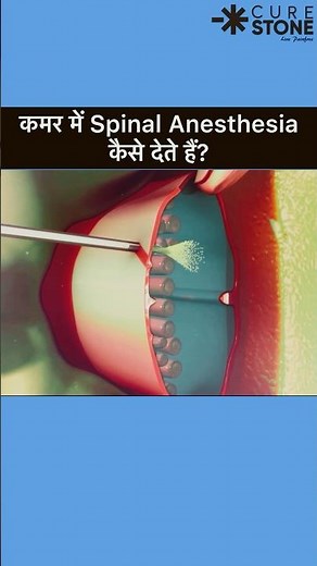 Spinal Anesthesia | How spinal is given | Epidural Anesthesia #rirssurgery #pregenency