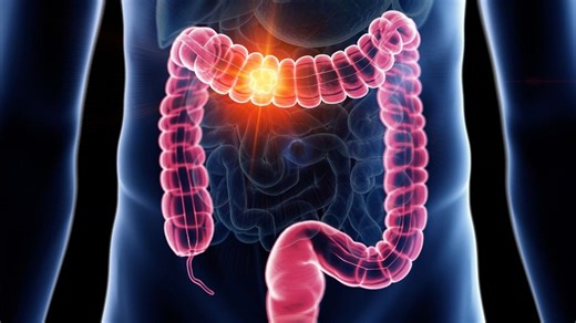 Doctor explains why bowel cancer is on the rise in young people