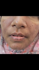 ♦️"A Typical Case of SLE" #SLE #Lupus #Rheumatology #SystemicLupusErythematosus #ClinicalCase #CaseStudy #DrSabbirHossain | Dr. Sabbir Hossain