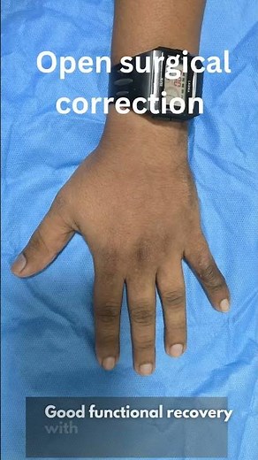 Boutonniere deformity of finger correction