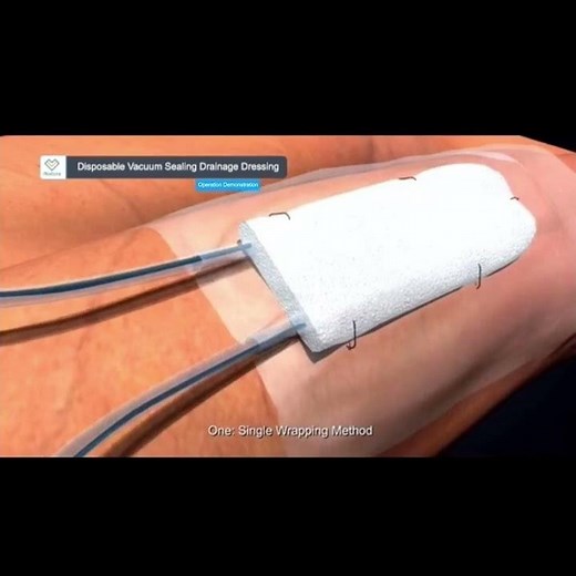 NPWT|Wound Dressing |The introduction to Disposable Vacuum Sealing Drainage Dressing|For Opthopedics