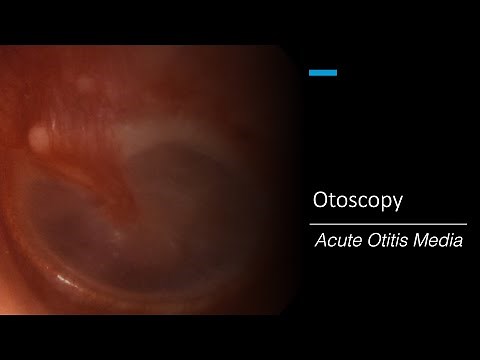 Acute Otitis Media: Otoscopy